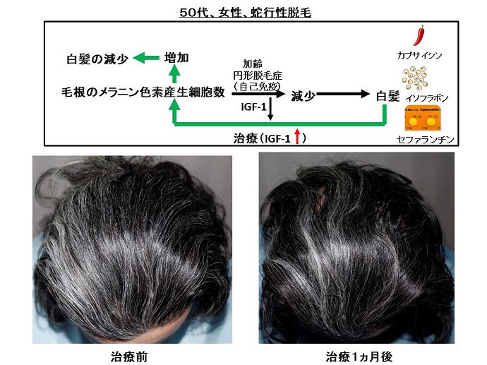 円形脱毛症　病院